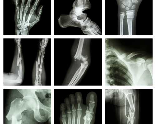 Fracture Management